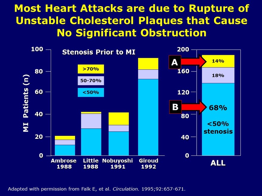 Mild to Moderate Plaques Cause Heart Attacks